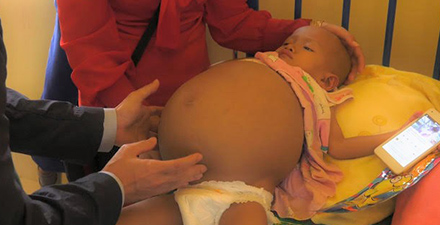 腎臓がんの３歳の女の子